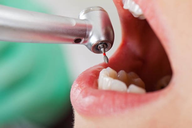 Best Emergency Root Canal Therapy in Coral Springs, FL